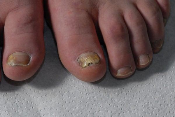 Nagelpilz Nagelmykose