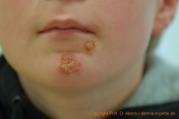 Impetigo contagiosa