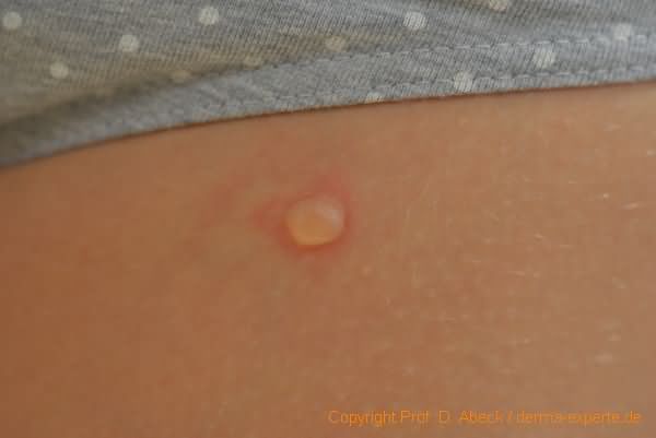 Impetigo contagiosa